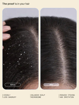 Arata - Anti-Dandruff Shampoo 200ml & Serum 30ml Combo – clinical results