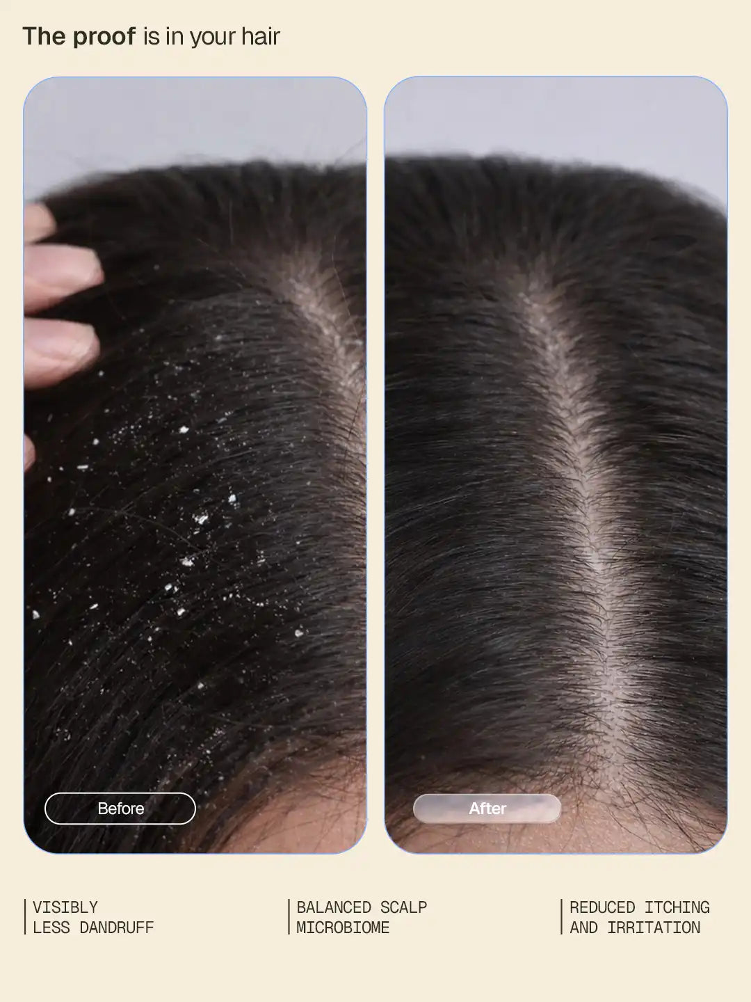 Arata - Anti-Dandruff Shampoo 200ml & Serum 30ml Combo – clinical results