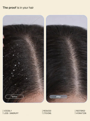 Arata - Anti-Dandruff Shampoo, Conditioner & Serum (Tonic) Combo – clinical results
